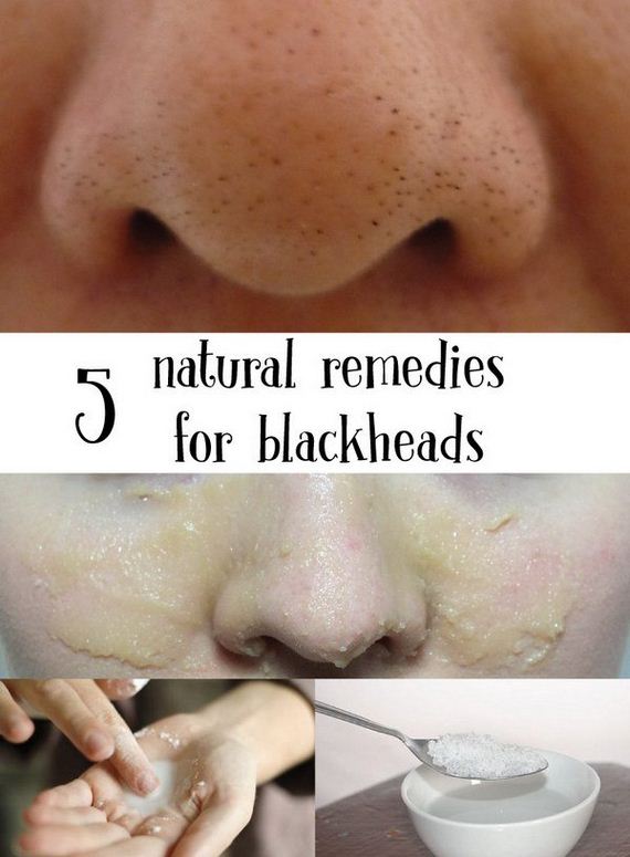 03-how-to-get-rid-of-blackheads