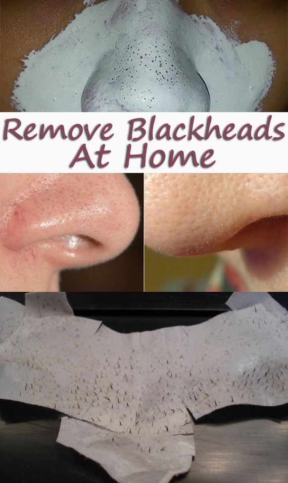 05-how-to-get-rid-of-blackheads