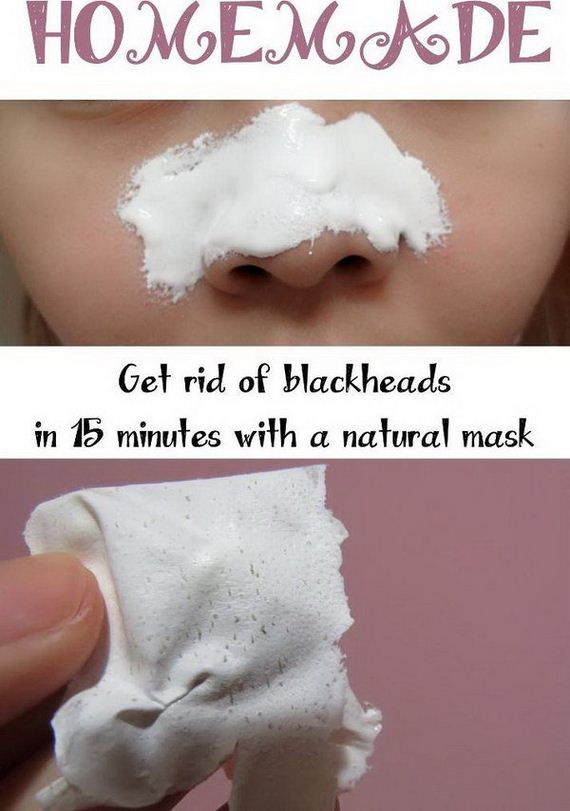 02-how-to-get-rid-of-blackheads