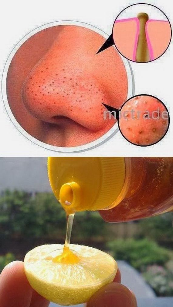 06-how-to-get-rid-of-blackheads
